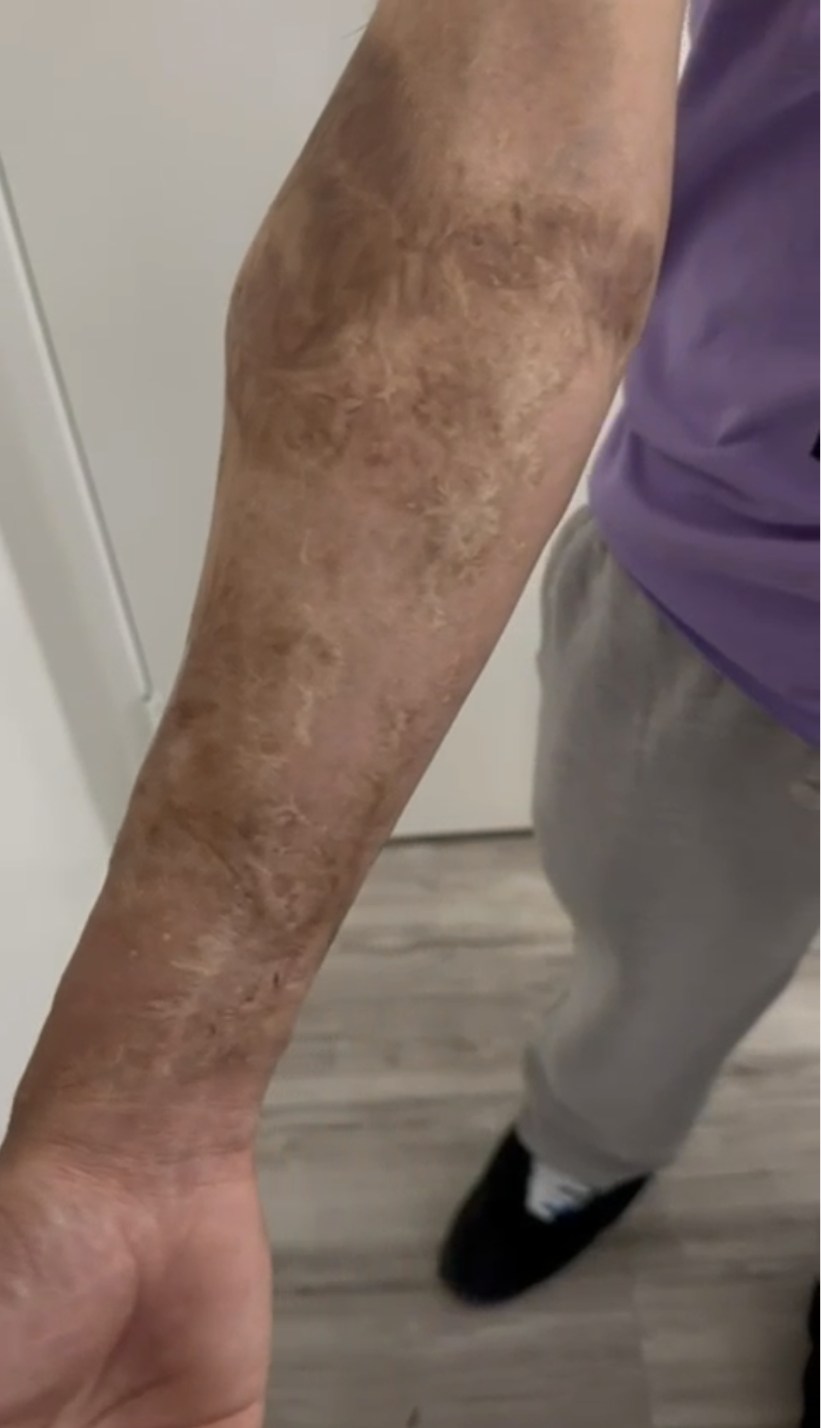 Before — Scar Coverage